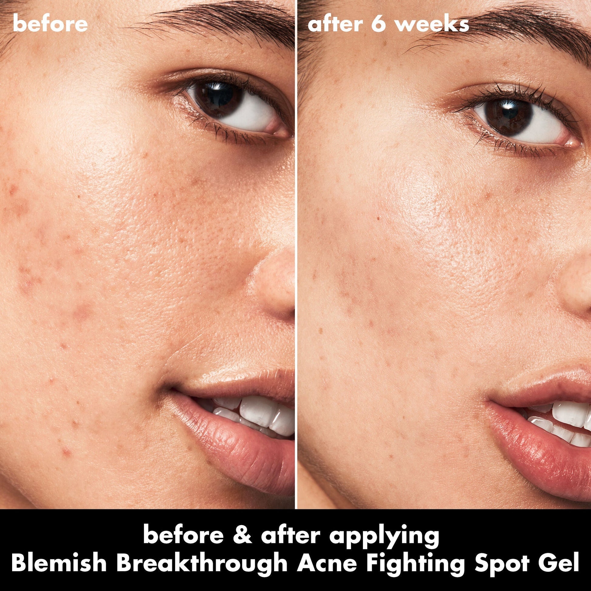 blemish-breakthrough-acne-fighting-spot-gel-e5 0326_EDU_BB_SpotGel_BA_ISABELLA.jpg