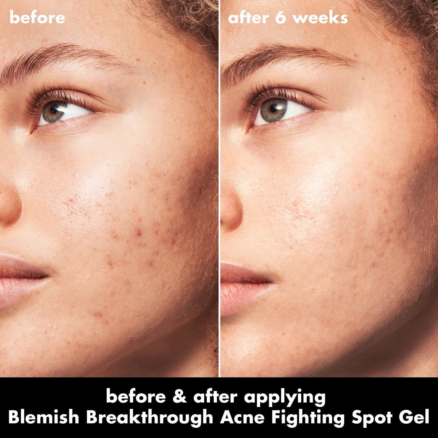 blemish-breakthrough-acne-fighting-spot-gel-e5 0326_EDU_BB_SpotGel_BA_MARLEY.jpg