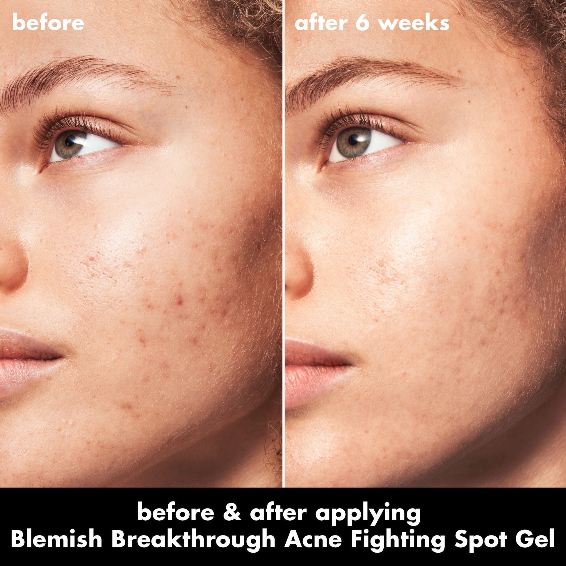 blemish-breakthrough-acne-fighting-spot-gel-e5 0326_EDU_BB_SpotGel_BA_MARLEY.jpg