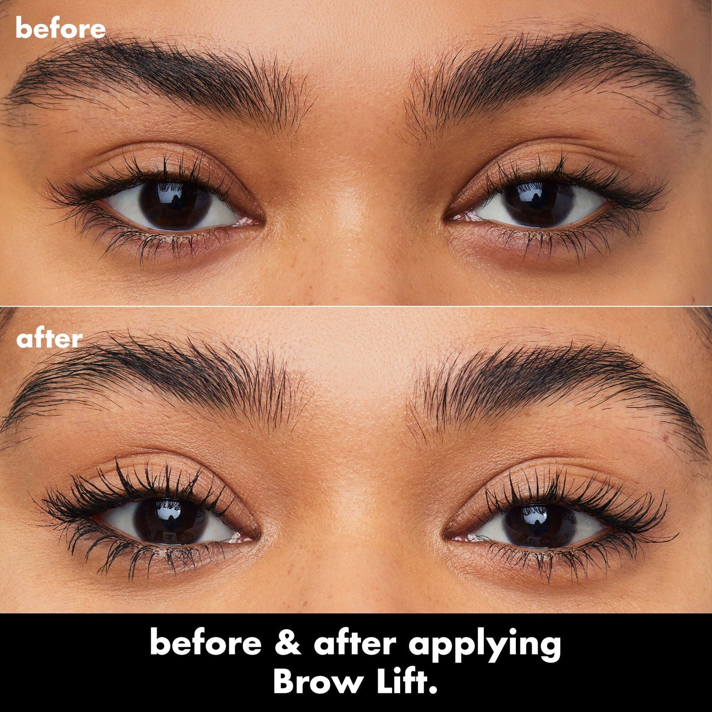 brow-lift-p2 0326_EDU_BrowLift_BA.jpg