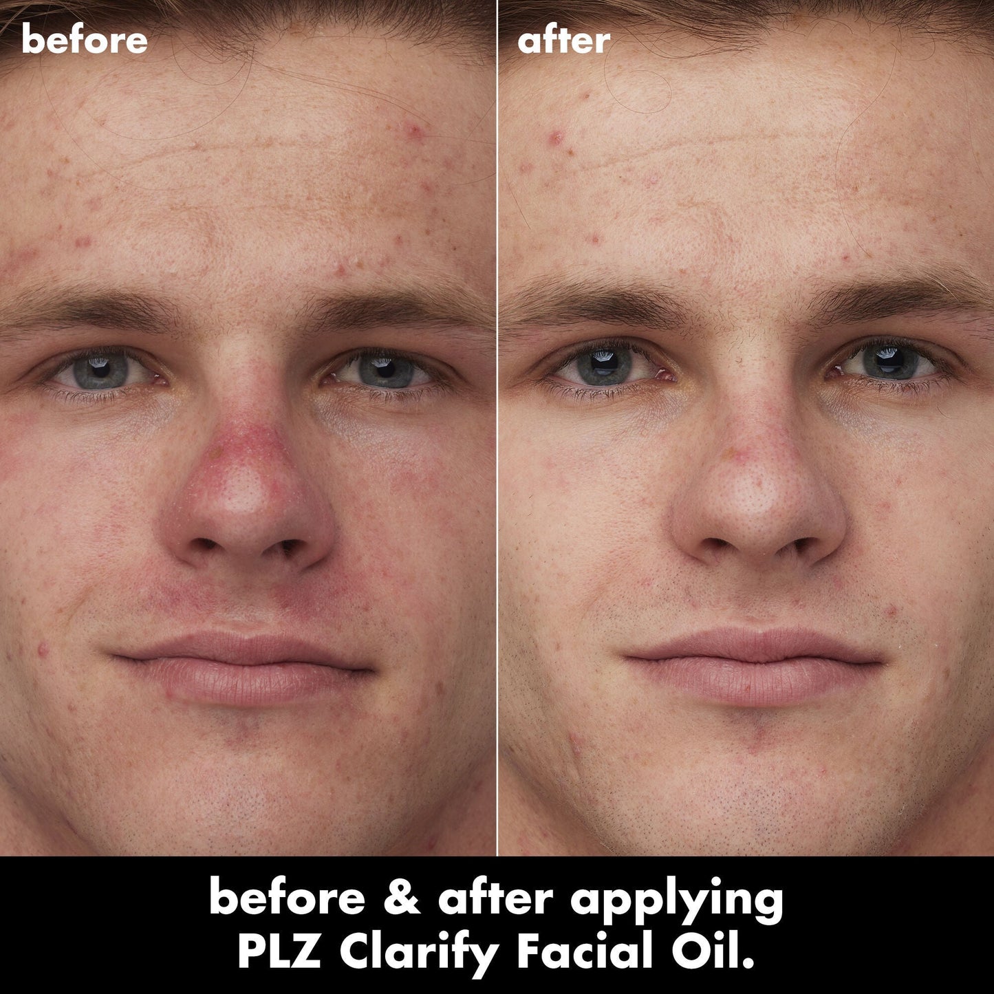 plz-clarify-facial-oil-w0 0326_EDU_PlzClarify_BA_Caleb.jpg