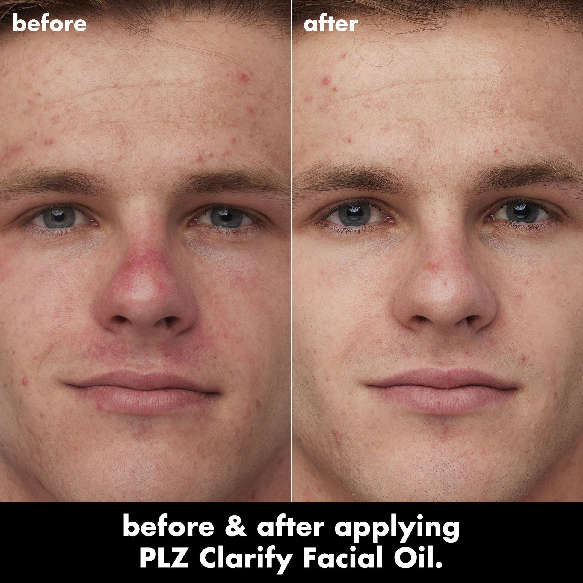 plz-clarify-facial-oil-w0 0326_EDU_PlzClarify_BA_Caleb.jpg