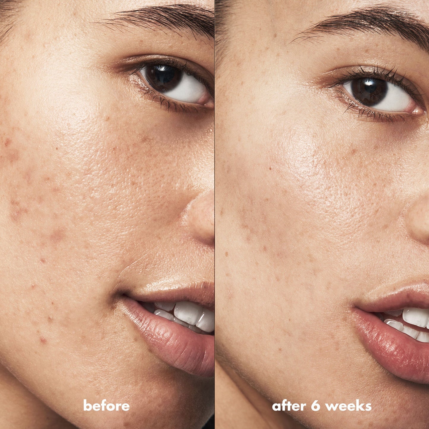 blemish-breakthrough-triple-acid-resurfacing-serum-m5 Acne_PDP_Isabella_Before_After_b8fe0505-ae5c-4baa-9a8e-fd889e4c3414.jpg