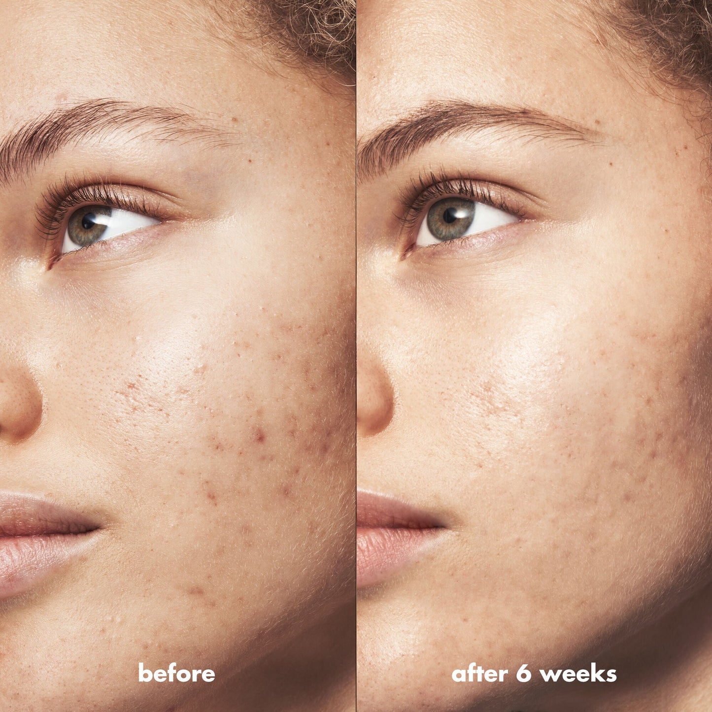 blemish-breakthrough-acne-clarifying-cleanser-c5 Acne_PDP_Marley_Before_After_216490cc-567c-424e-91eb-5374368f15d6.jpg